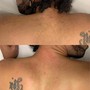 Back Treatment