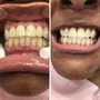 Teeth Whitening