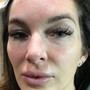 Eyelash Extension Removal