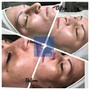 Microdermabrasion with Oxygen