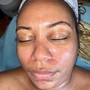 Acne Facial Treatment