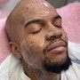 Microdermabrasion  Facial