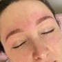 Microdermabrasion  Facial