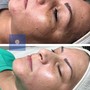 Diamond Microdermabrasion