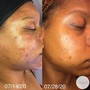 Chemical peel