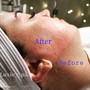 MicroNeedling