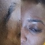 Microdermabrasion