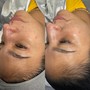 Chemical peel