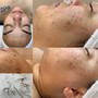 Microdermabrasion Facial