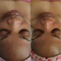 Facial