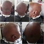 Alopecia Scalp Treatment