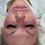 MICRONEEDLING FACIAL