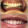 TEETH WHITENING MASTERCLASS