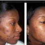 Chemical peel