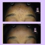 Add On Dermaplaning