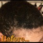 Scalp Treatment