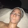 Acne Facial