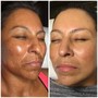 Resurfacing Treatment