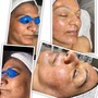 Dermaplaning  facial