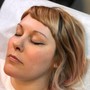 Chemical peel Facial treatment