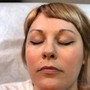 *SALE!-Facial Cupping treatment