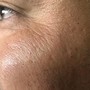 MicroNeedling