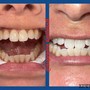 1 Hour Session Teeth Whitening 60 Min