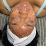 Glycolic Peel