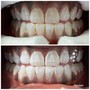 Couples Whitening