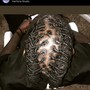 Scalp Treatment