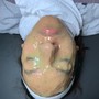 Acne Facial