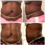 LipoSculpt 7 Day follow up