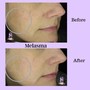 MicroNeedling Eyes