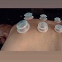 Cupping