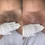 Microdermabrasion