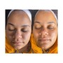 Custom Chemical Peel