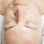 Full Face, Neck and Back Rejuvenation Treatment