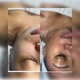 Microdermabrasion facial