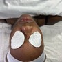 Microdermabrasion facial