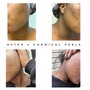 Microneedling Chest