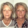 BOTOX GLOWTOX FACIAL