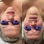 Oxygen Facial