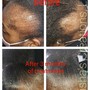 Scalp Treatment