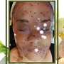 Chemical Facial peel