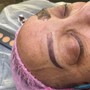 Microdermabrasion