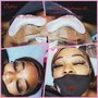 ACNE FACIAL WITH HYPERPIGMENTATION