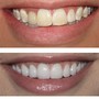 Pro Teeth Whitening 30 Minutes