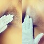 Underarm Treatment