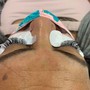 MicroNeedling