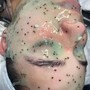 Acne Facial